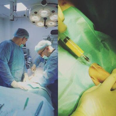 L'ispessimento del pene è possibile con l'aiuto della chirurgia