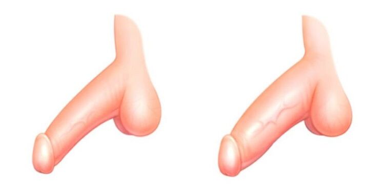 pene prima e dopo l'ingrandimento